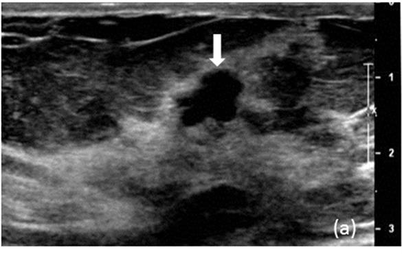 This ultrasound image shows a breast mass (at arrow) highly suspicious of cancer. A biopsy revealed ductal carcinoma in situ, the earliest form of breast cancer with low risk of becoming invasive. (Radiology, Aug. 2016)